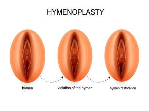 Hymenoplasty treatment in Gurgaon