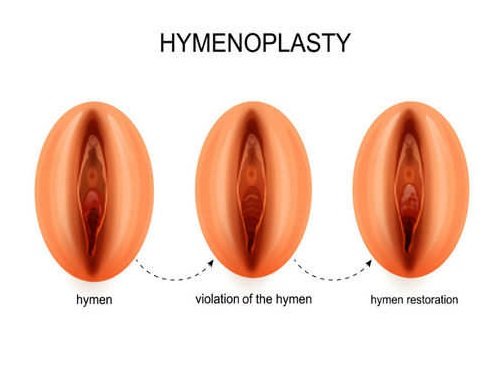 best hymen repair surgery in Delhi
