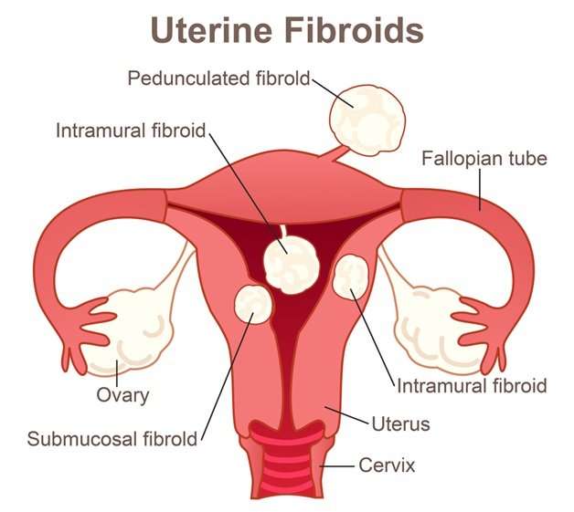 fibroid treatment in Gurgaon