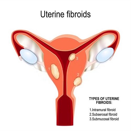 Types of fibroid