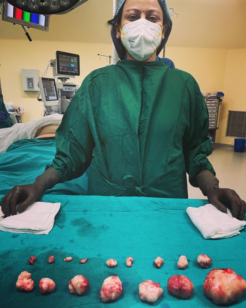 uterine fibroidsl
