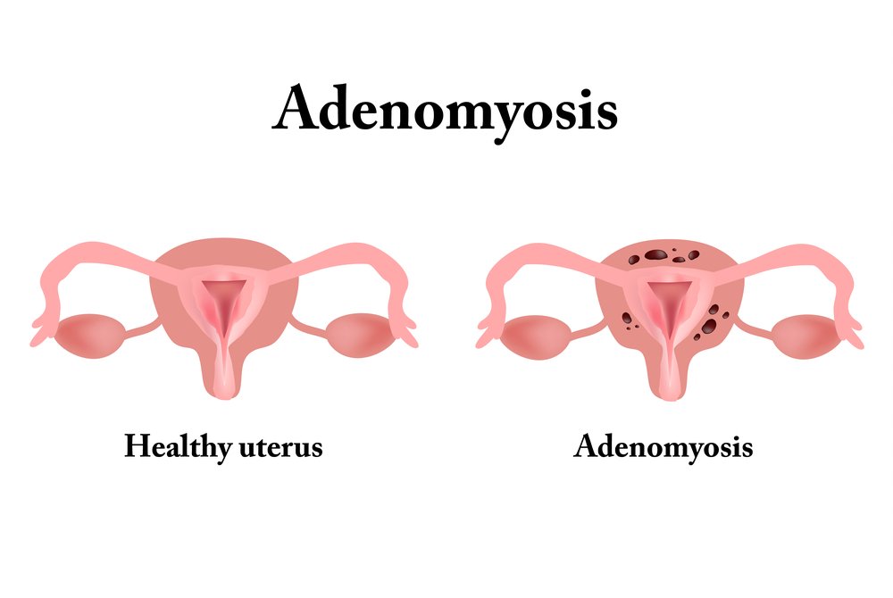 Adenomyosis Surgery in Gurgaon