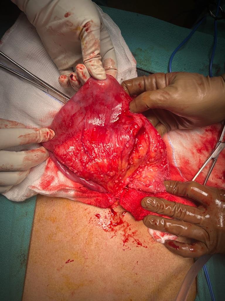 Bowel loops studded with nodules