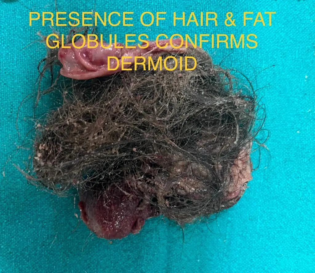 Dermoid cysts removal
